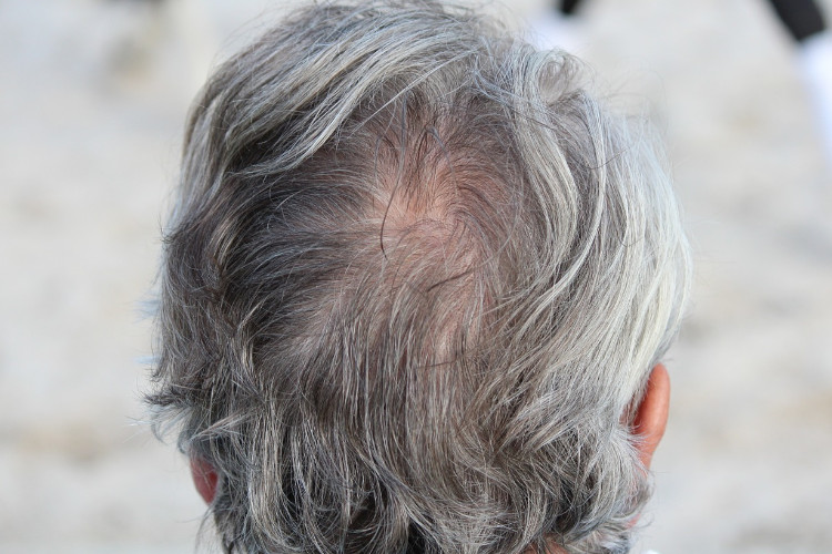 Scientists Finally Figure Out How Stress Turns Hair Gray